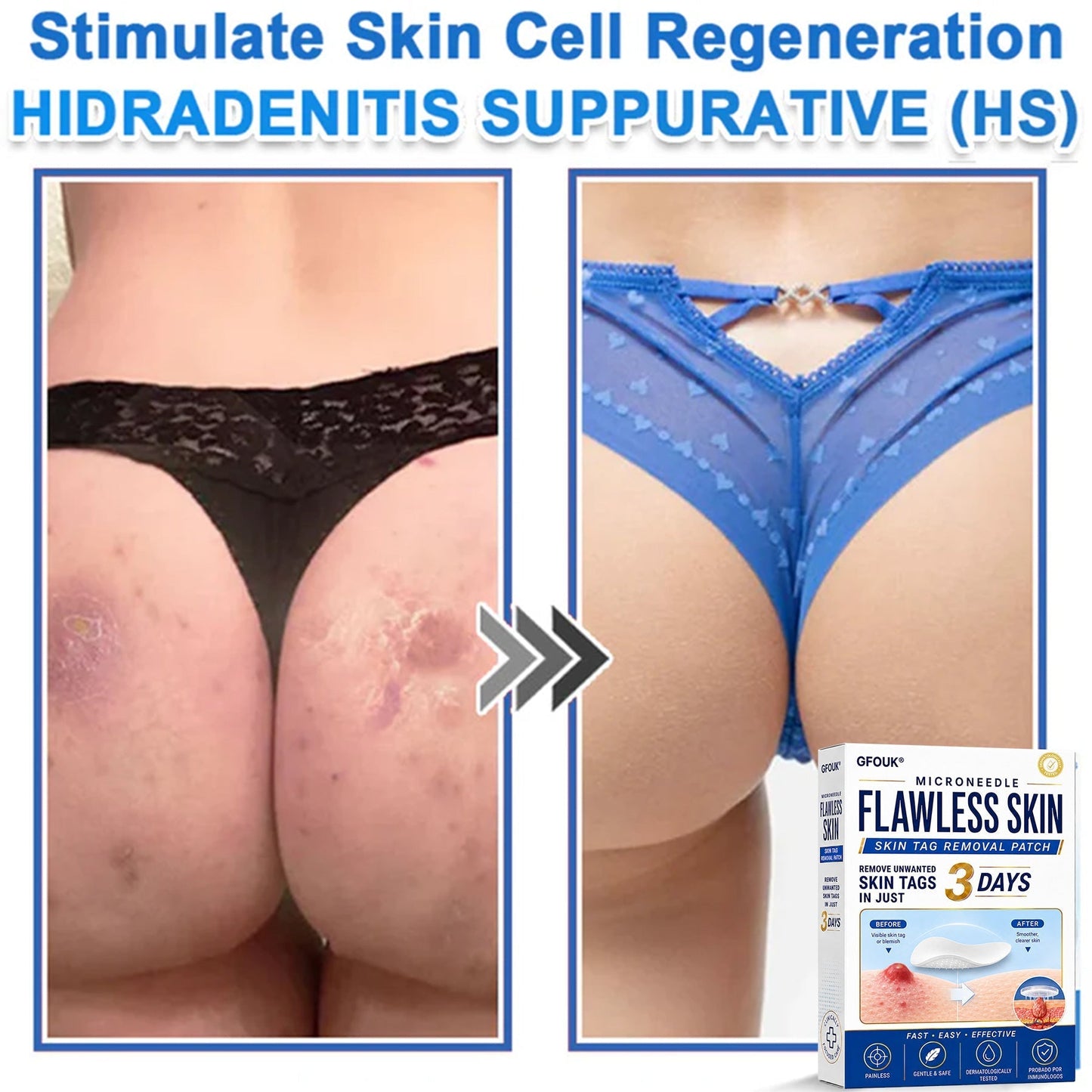 💫GFOUK® 2026 Newly Upgraded 2-in-1 Microneedle Hydrocolloid Patches | Removes Raised Moles, Acne, Flat Warts, and Skin Tags | Improves Wrinkles, Scars, and Blemishes | Invisible Acne Patches for Face & Body