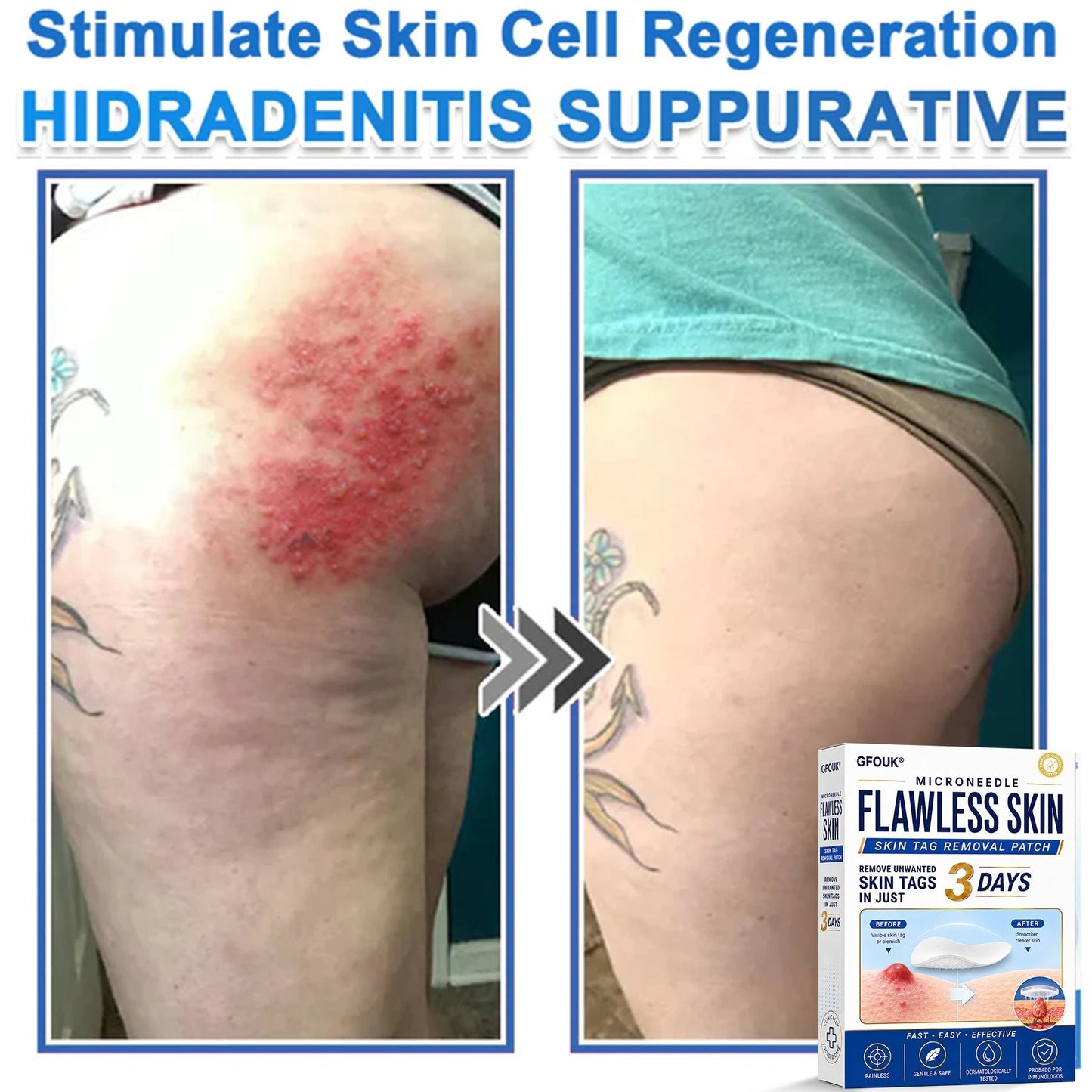 💫GFOUK® 2026 Newly Upgraded 2-in-1 Microneedle Hydrocolloid Patches | Removes Raised Moles, Acne, Flat Warts, and Skin Tags | Improves Wrinkles, Scars, and Blemishes | Invisible Acne Patches for Face & Body