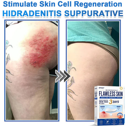 💫GFOUK® 2026 Newly Upgraded 2-in-1 Microneedle Hydrocolloid Patches | Removes Raised Moles, Acne, Flat Warts, and Skin Tags | Improves Wrinkles, Scars, and Blemishes | Invisible Acne Patches for Face & Body