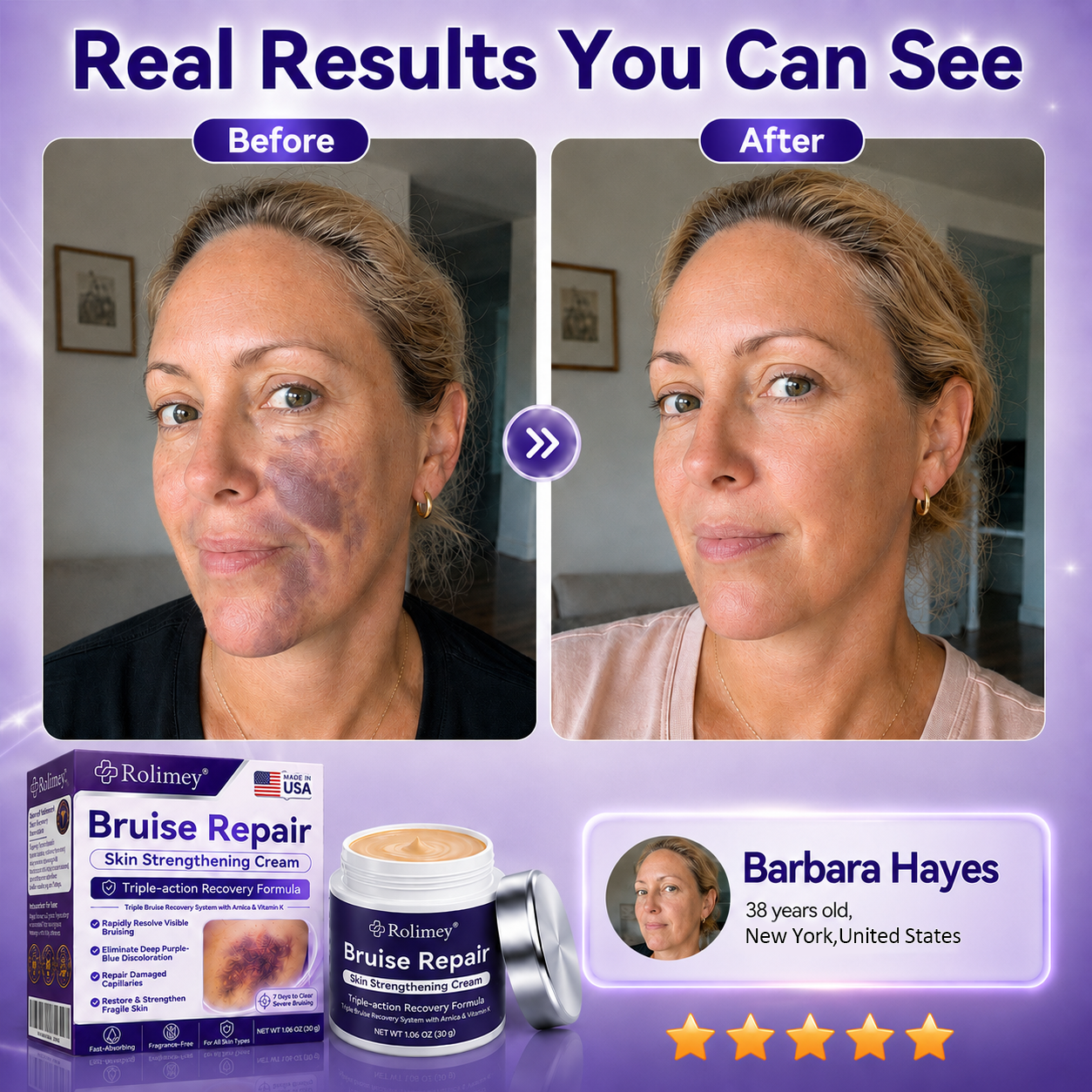 👨‍⚕️Over 100,000 units sold💕 - Rolimey® cream to repair bruises and strengthen the skin