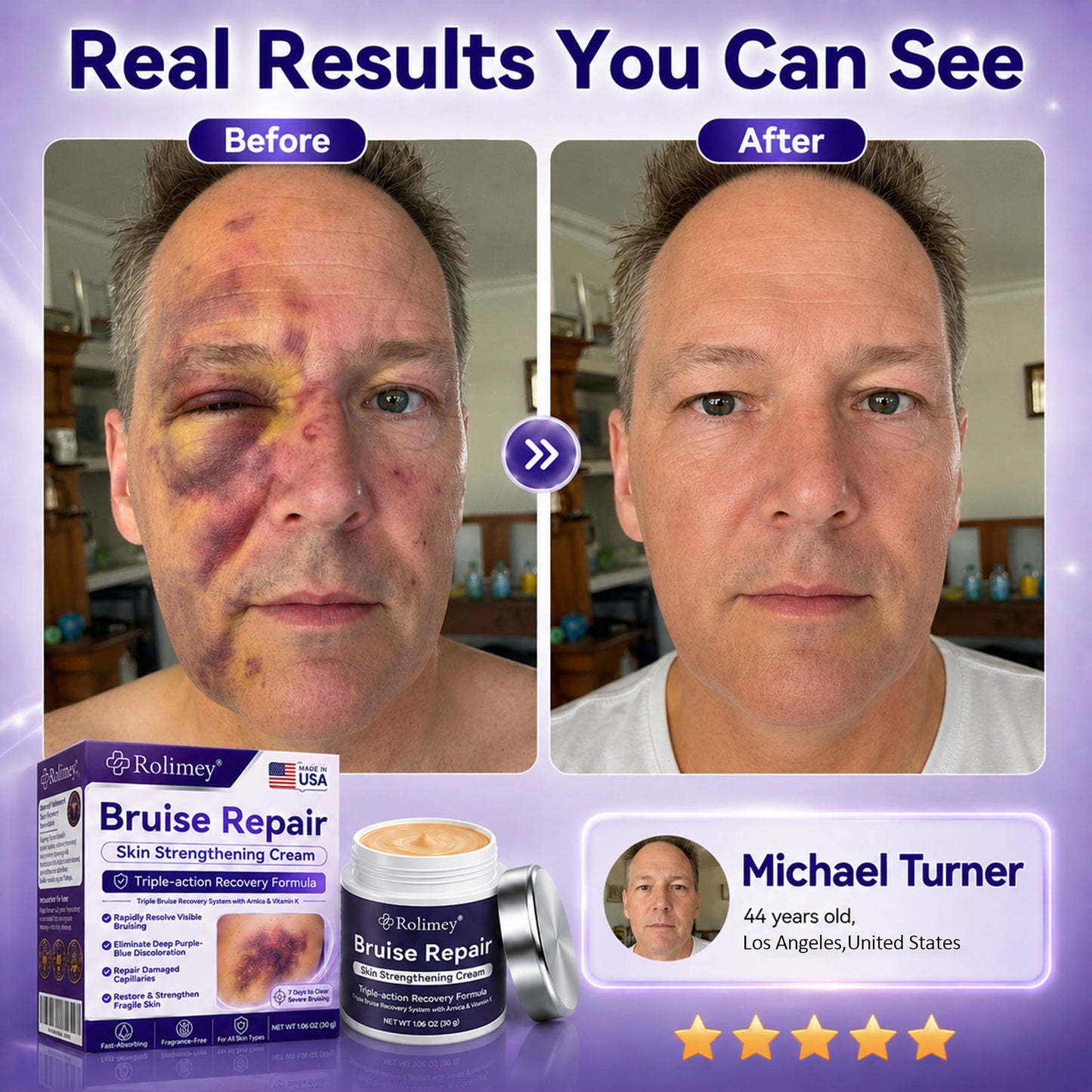 👨‍⚕️Over 100,000 units sold💕 - Rolimey® cream to repair bruises and strengthen the skin