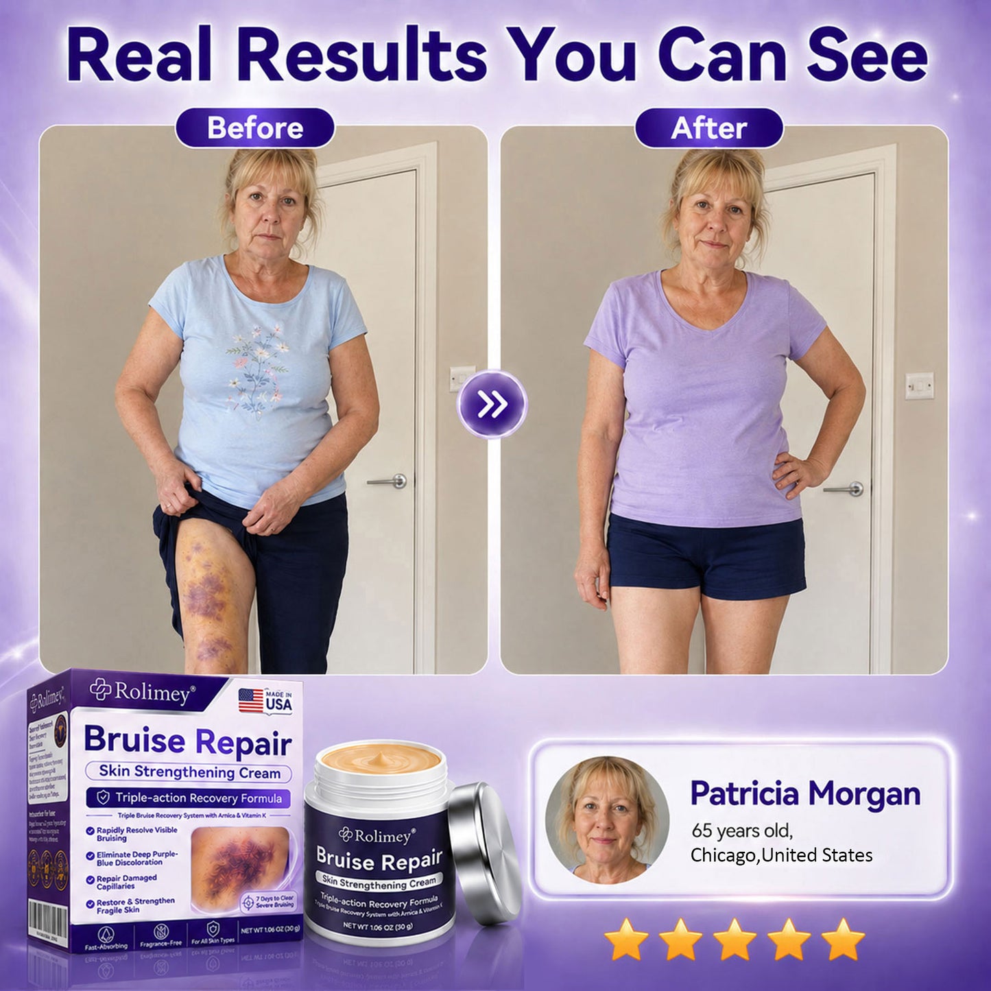 👨‍⚕️Over 100,000 units sold💕 - Rolimey® cream to repair bruises and strengthen the skin