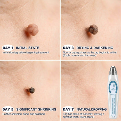 💕Official Brand Shop | Rolimey® 7-Day Roll-On for Skin Spots and Skin Tags – Pain-Free & Scar-Free