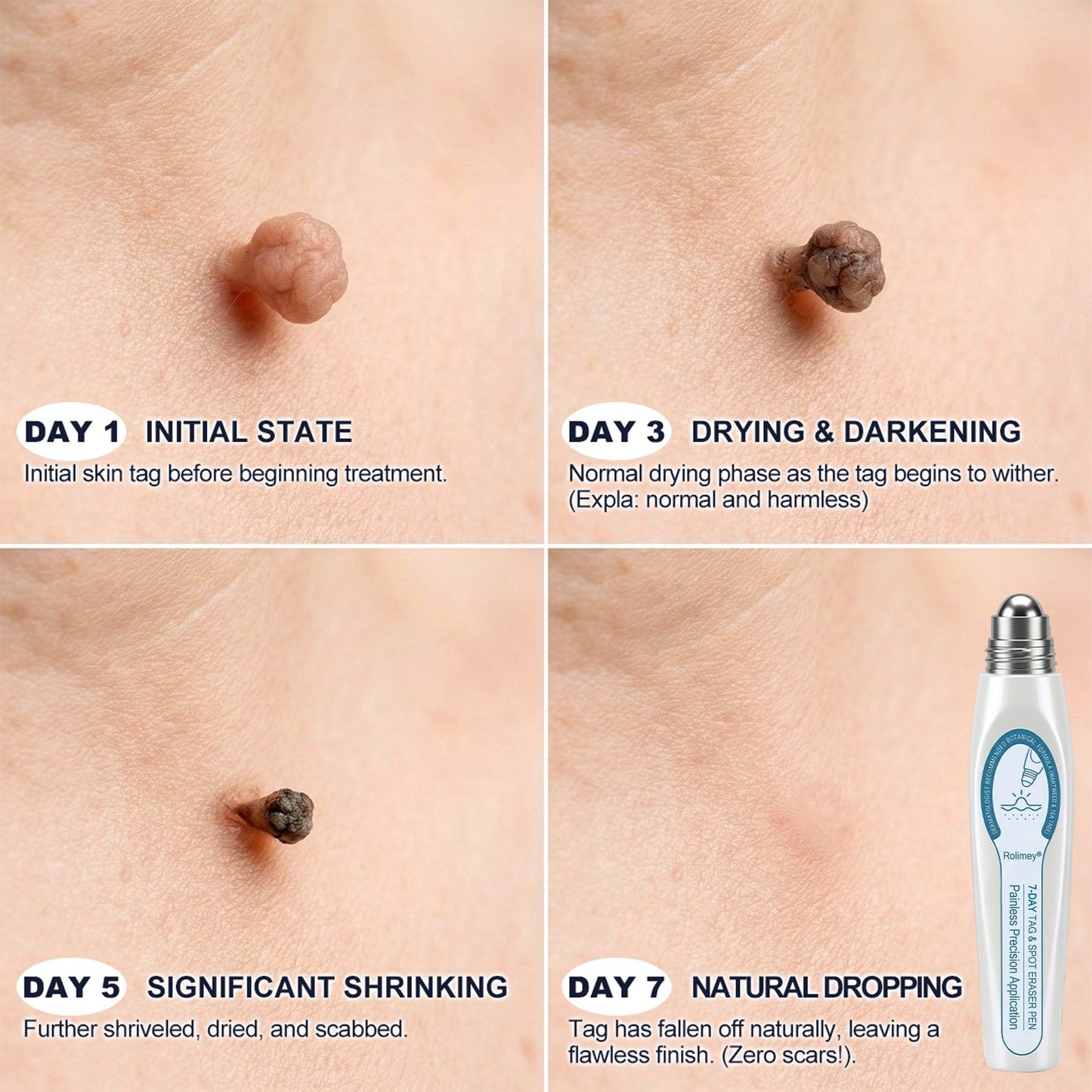 ❤️Official Brand Shop | Rolimey® 7-Day Roll-On for Skin Spots and Skin Tags – Pain-Free & Scar-Free