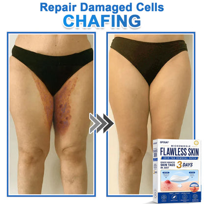 💫GFOUK® 2026 Newly Upgraded 2-in-1 Microneedle Hydrocolloid Patches | Removes Raised Moles, Acne, Flat Warts, and Skin Tags | Improves Wrinkles, Scars, and Blemishes | Invisible Acne Patches for Face & Body