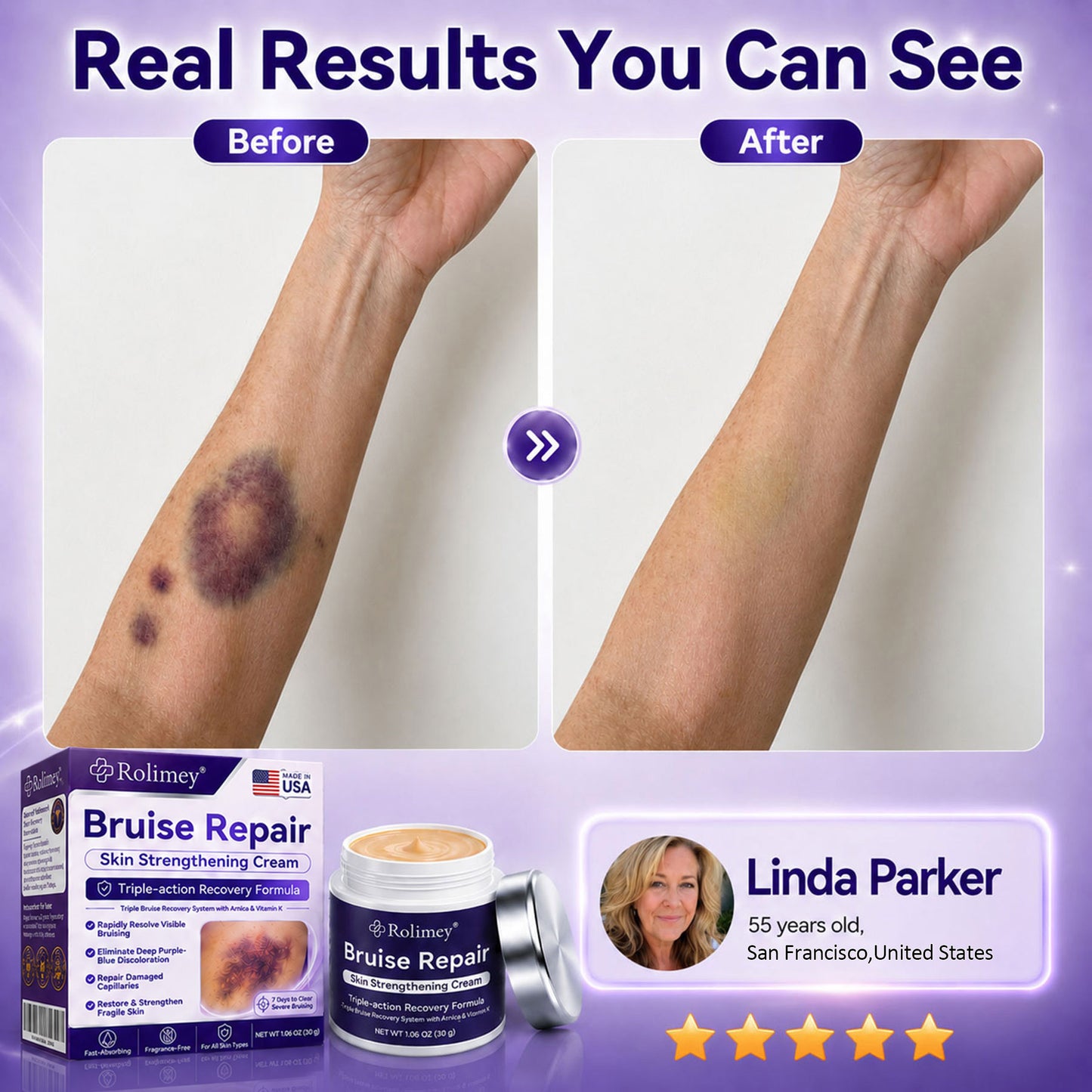 👨‍⚕️Over 100,000 units sold💕 - Rolimey® cream to repair bruises and strengthen the skin