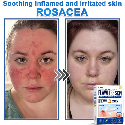 💫GFOUK® 2026 Newly Upgraded 2-in-1 Microneedle Hydrocolloid Patches | Removes Raised Moles, Acne, Flat Warts, and Skin Tags | Improves Wrinkles, Scars, and Blemishes | Invisible Acne Patches for Face & Body