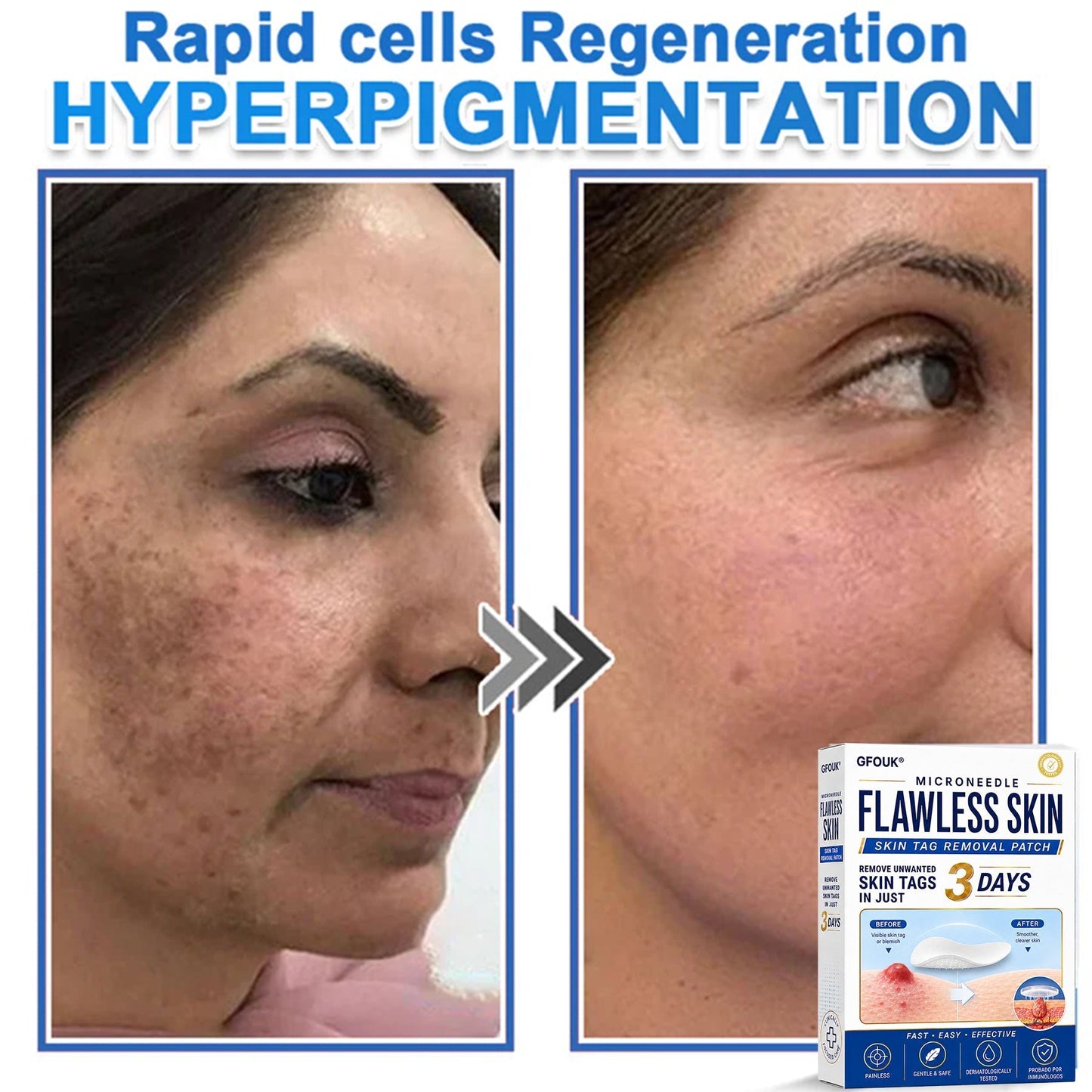 💫GFOUK® 2026 Newly Upgraded 2-in-1 Microneedle Hydrocolloid Patches | Removes Raised Moles, Acne, Flat Warts, and Skin Tags | Improves Wrinkles, Scars, and Blemishes | Invisible Acne Patches for Face & Body